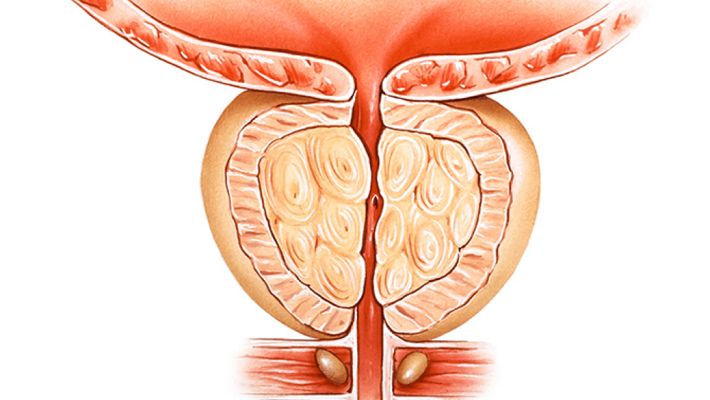Benign prostatic hyperplasia (BPH)